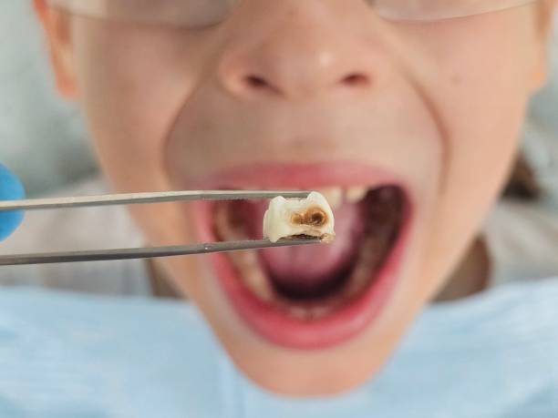 Best Cracked Tooth Emergency Dentist  in Clinton, OH